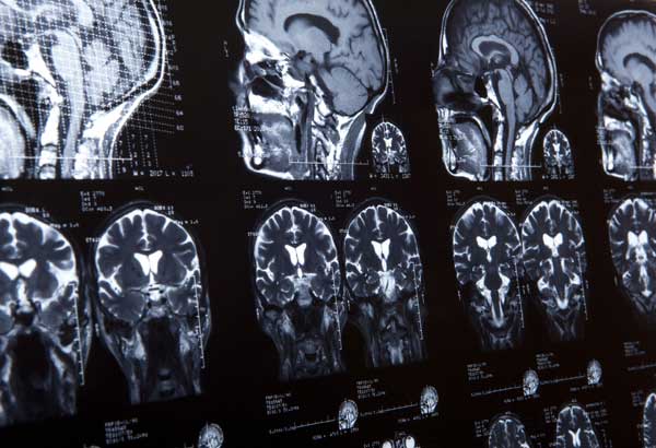 Brain Scans of MRI